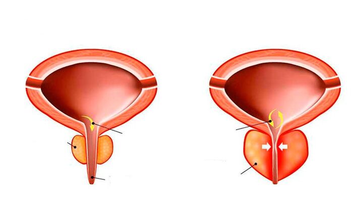 Prostate normal et enflammé