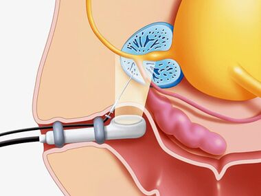 Biopsie à l'aiguille de la prostate.
