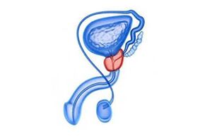 dessin d'inflammation de la prostate