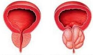 Prostate saine et enflammée