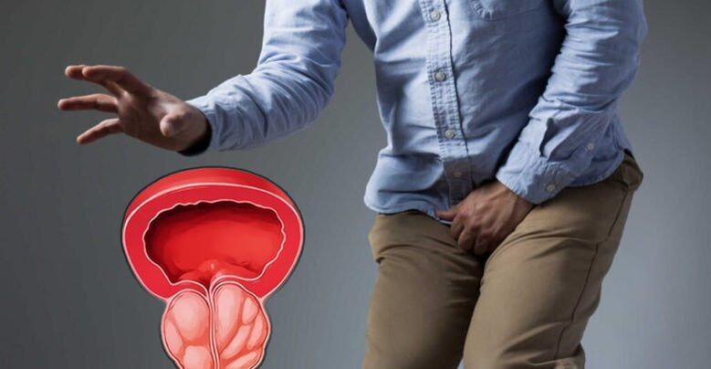 Prévention de la prostatite et adénome de la prostate